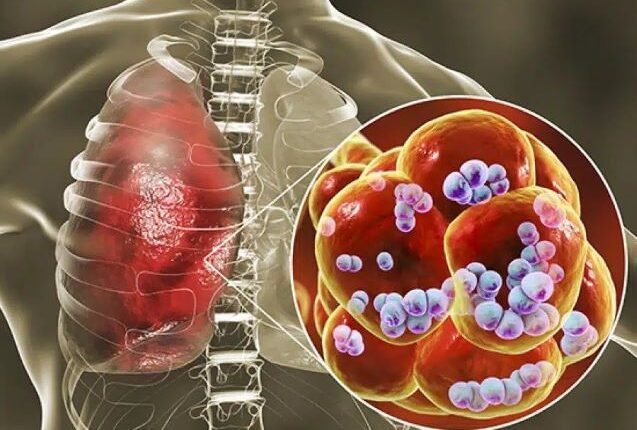 Εποχική-γρίπη-και-πνευμονιοκοκκικές-λοιμώξεις:-Τι-πρέπει-να-γνωρίζουμε