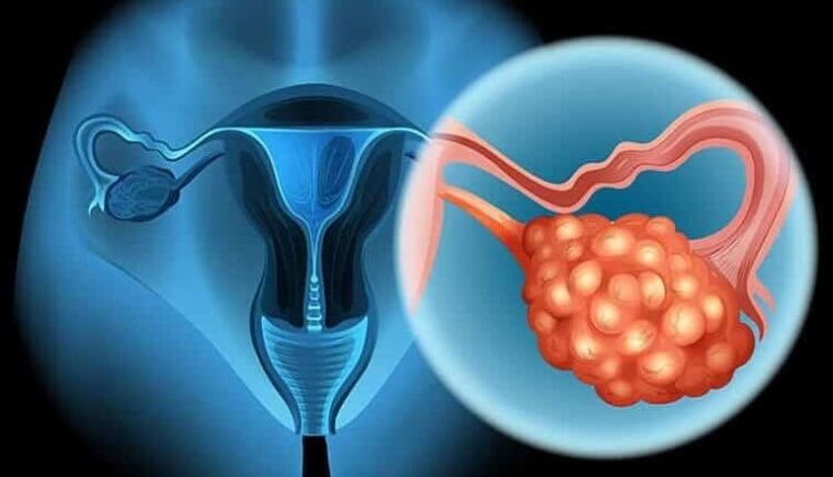 Καρκίνος-των-ωοθηκών:-Η-σιωπηλή-νόσος-και-η-θεραπεία-με-τους-parp-αναστολείς