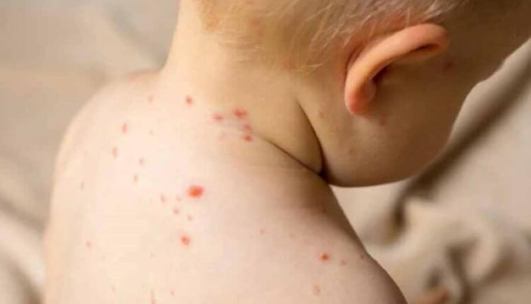 Οκτώ-τα-επιβεβαιωμένα-κρούσματα-Ιλαράς-στη-χώρα-μας