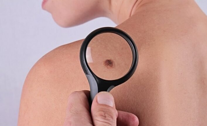 Μελάνωμα και-έγκαιρη-διάγνωση – Πού-θα-κάνετε-δωρεάν-εξέταση
