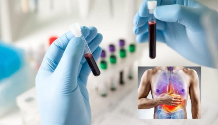Νέο-τεστ-αίματος-ανιχνεύει-με-ακρίβεια-90%-τον-καρκίνο-του-στομάχου