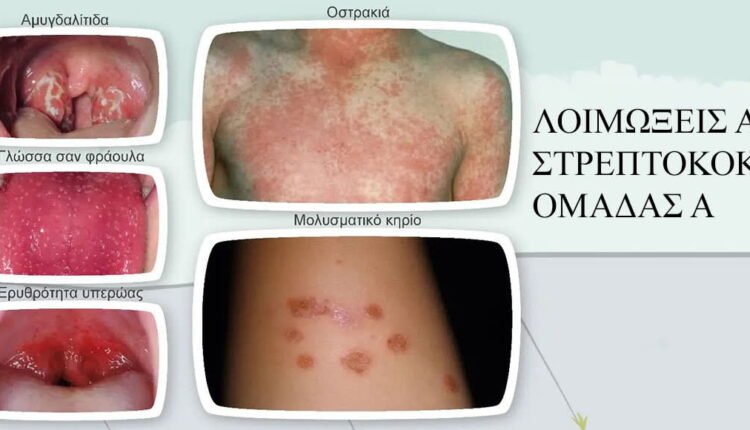 ΕΟΔΥ:-Δεν-βρέθηκε-κοινή-έκθεση-σε-στρεπτόκοκκο-Α-στα-περιστατικά-στην-Ηλεία
