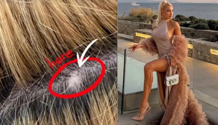 Τούνη:-«Όταν-στρεσάρομαι-βγάζω-τριχοφάγους,-αλλά-είναι-καλύτερα-από-σοβαρότερα-προβλήματα-υγείας»