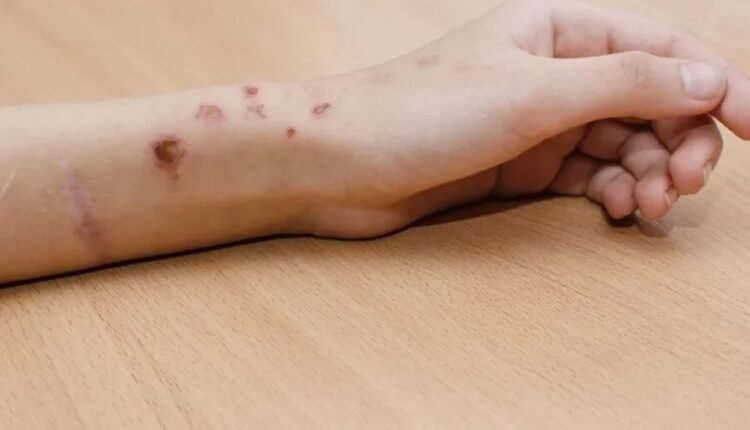 Ένα-στα-έξι-παιδιά-αυτοτραυματίζεται-στη-χώρα-μας